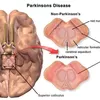 Parkinson Bukan Akhir Segalanya, Teknologi Otak Kini Buka Harapan Baru
