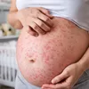 Mengenal PUPPP saat Hamil, Ruam Gatal yang Sering Bikin Ibu Tidak Nyaman