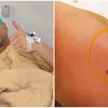 Berkaca dari Raffi Ahmad, Kenali Gejala Lipoma atau Tumor Jinak yang Berawal dari Benjolan Kecil, Kapan Harus Segera Dioperasi?