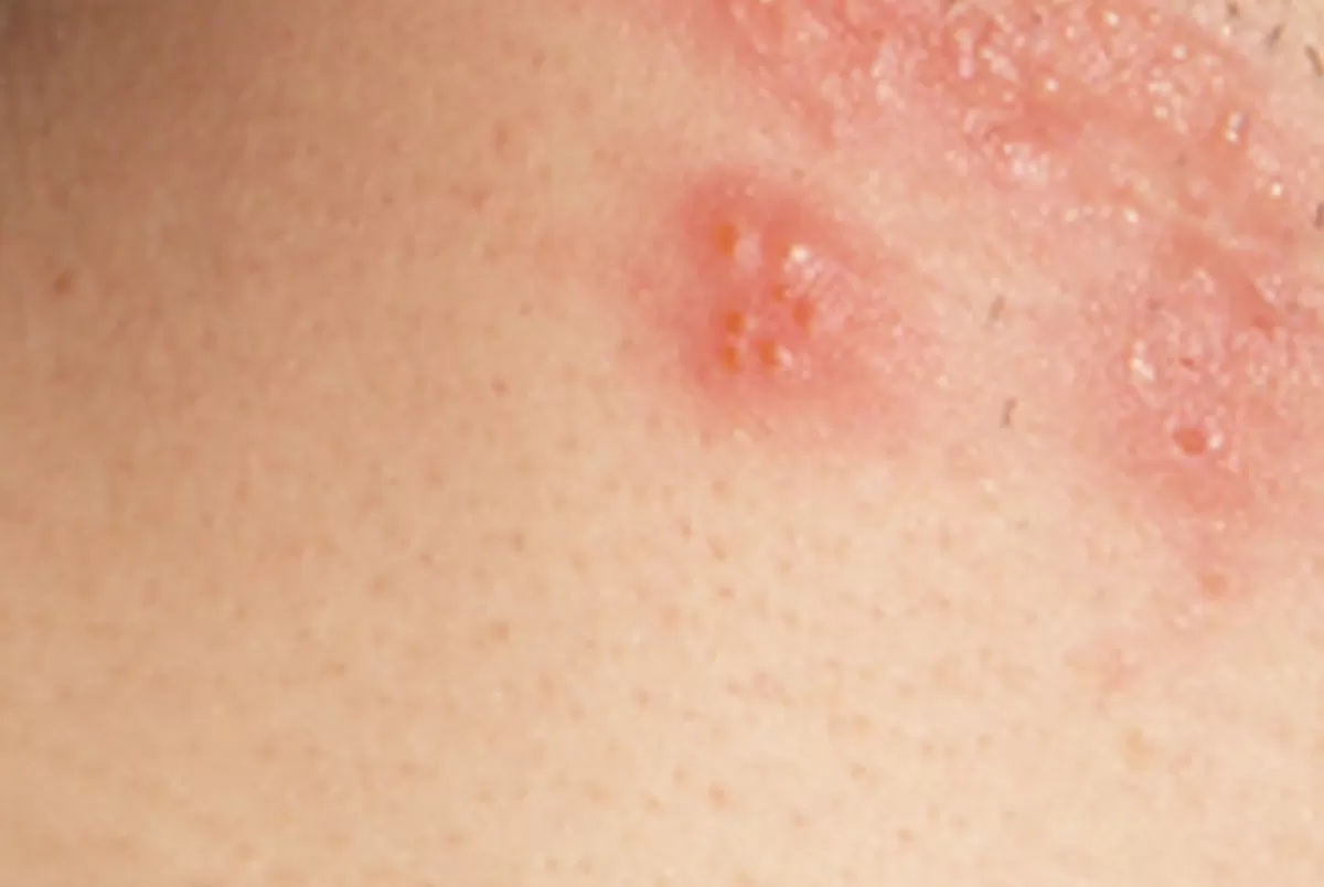 [Ilustrasi] Herpes Zoster (HZ) atau cacar api  (Wikipedia)