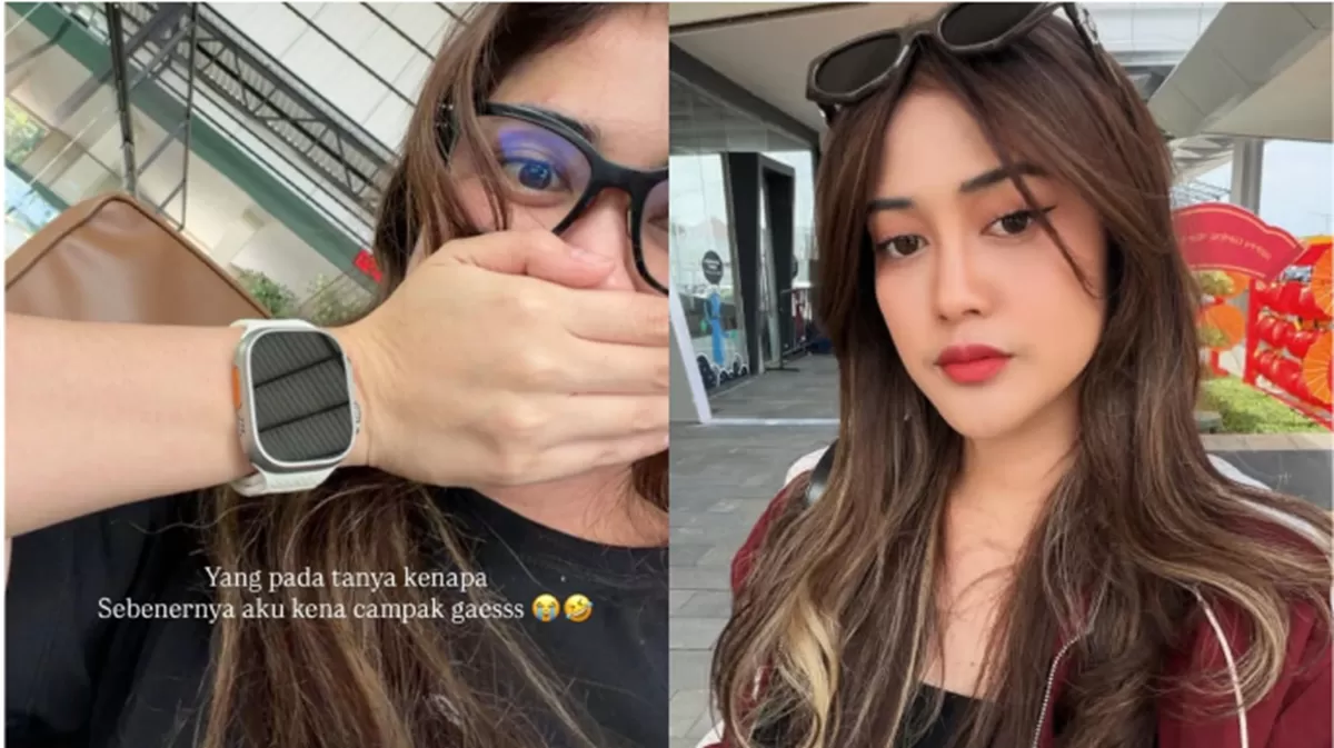 Selebgram Ruce Nuenda viral karena sempat berada di tempat umum saat sakit campak.