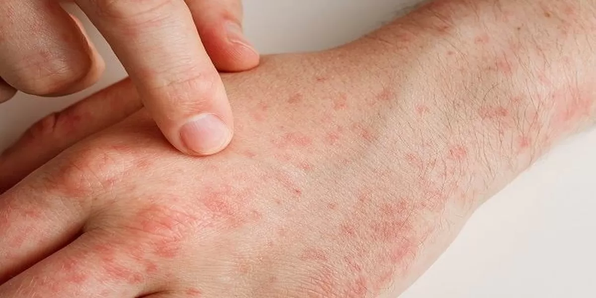Cara Ampuh Menghilangkan Bintik-Bintik Gatal di Kulit: Penyebab ...