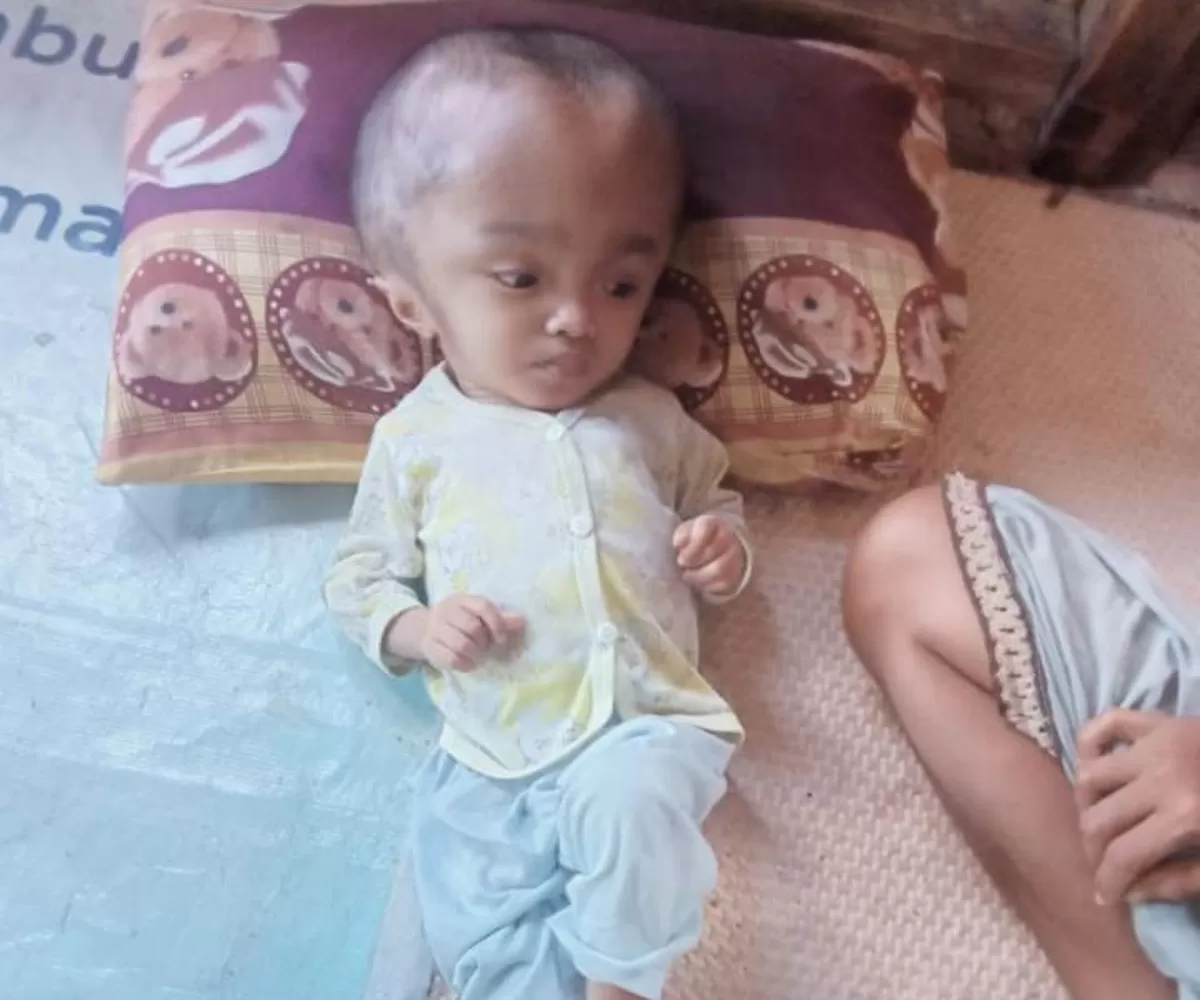 Maria, bocah perempuan berusia 3 tahun, kini bertaruh nyawa melawan penyakit yang membuat kepalanya terus membesar  (Foto: J. S-Idenusantara.com)
