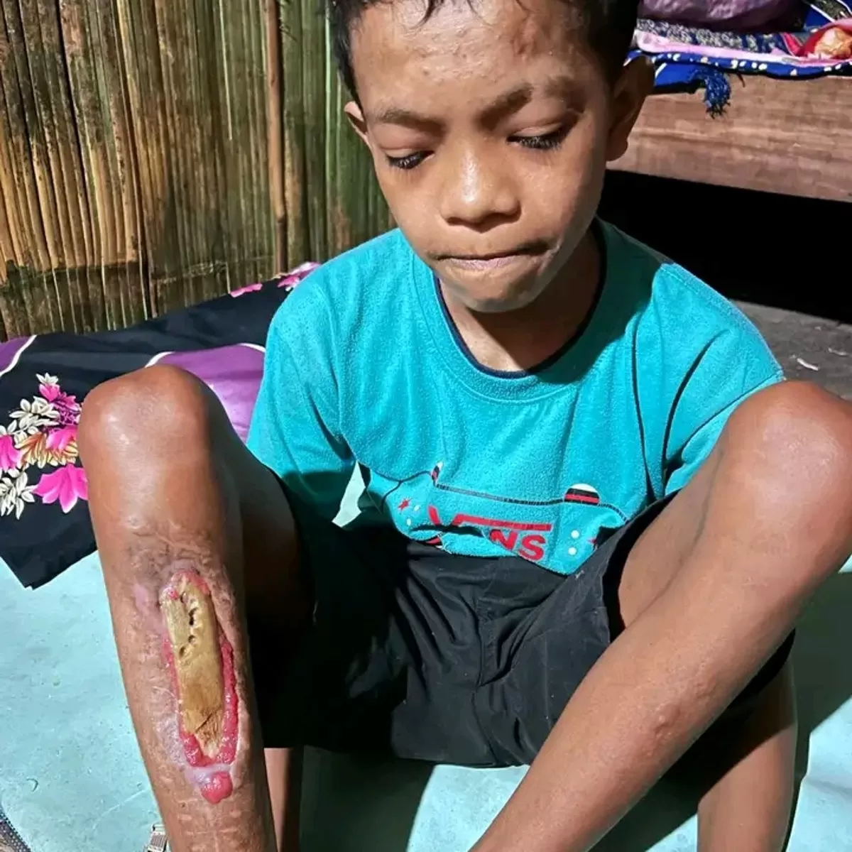 Fandi divonis menderita osteomielitis tibia atau infeksi tulang kering akibat bakteri. (Foto:Dok.Eccyk)