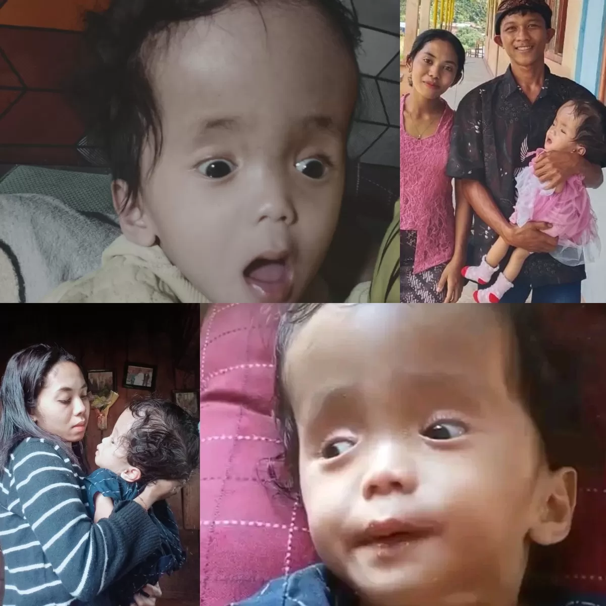 Stefania, Bayi Malang di Manggarai Timur Yang Berjuang Lawan Hidrosefalus (Foto: J.S-Idenusantara.com)