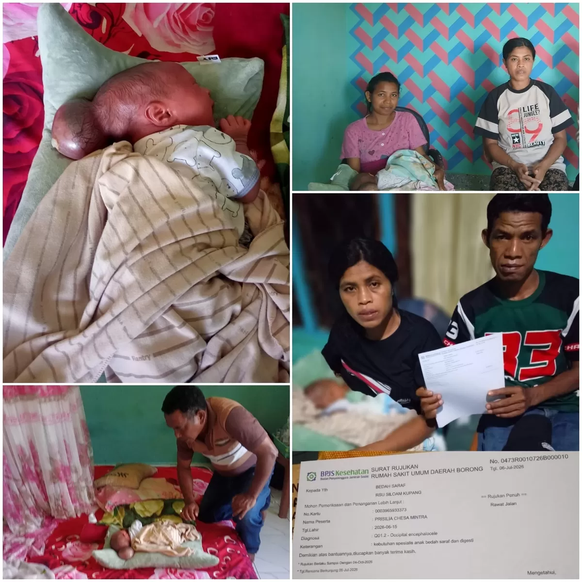 "Mama Peluk Terus Biar Adik Tidak Sakit" - Prisilia, Bayi 2 Minggu Berjuang Lawan Benjolan di Kepala, Orang Tua Pasrah Menanti Bantuan (Foto: Jhi. S)