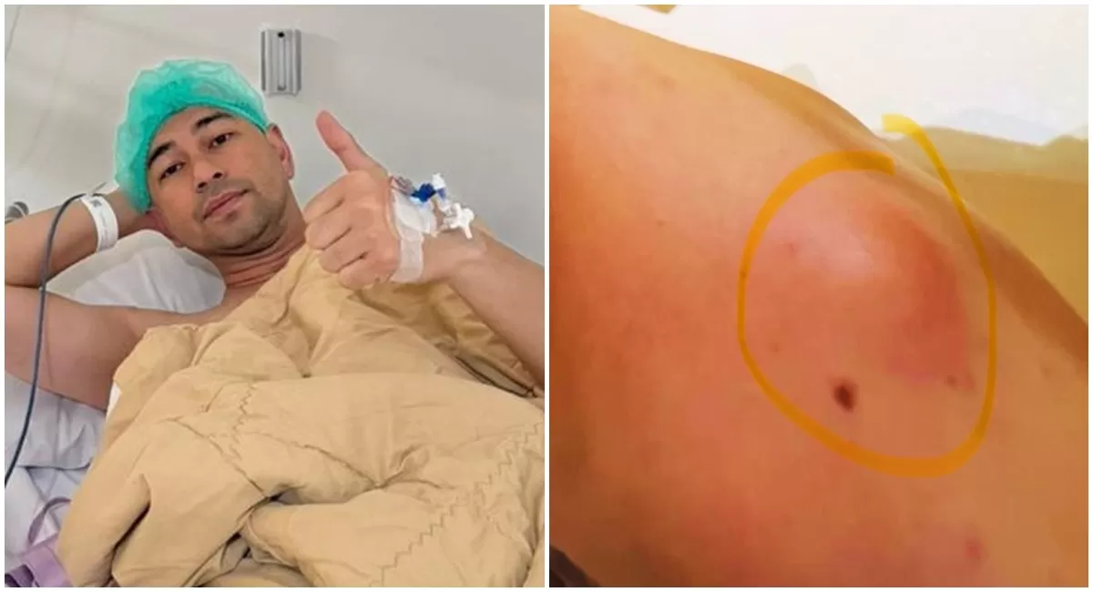 Potret Raffi Ahmad pasca menjalani operasi pengangkatan lipoma (Instagram/raffinagita1717)