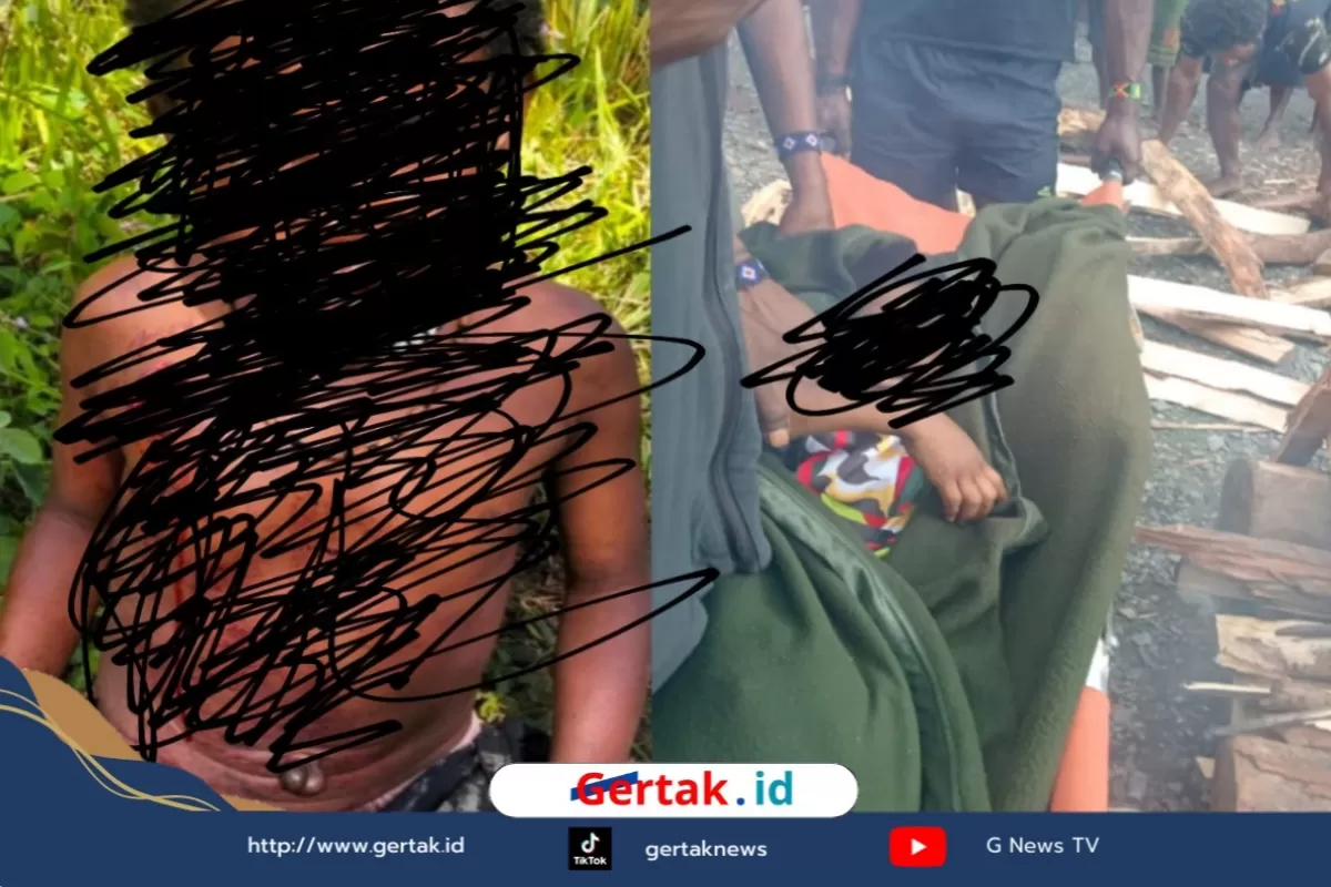 Anak Korban Operasi Militer Kemburu Meninggal Setelah 36 Hari Dirawat