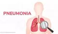 Cara Deteksi Pneumonia Menurut Dokter Spesialis