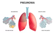 Penyebab, Gejala, dan Pengobatan Penyakit Pneumonia