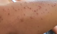 Muncul Jerawat di Tangan, Penyebab, dan Cara Mengatasinya
