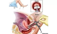 Begini cara mengeliminasi kanker serviks menurut dokter