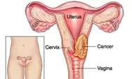 Kenali 15 ciri kemunculan Kanker Serviks pada wanita yang perlu dikenali sejak dini, salah satunya adalah perubahan siklus menstruasi