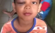 Korban Permainan Lato-lato, Mata Anak Ini Bengkak Sebesar Telur