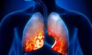 Jangan Tertukar! Ini 4 Gejala TBC yang Berbeda dari Flu Biasa