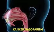 Kanker Nasofaring, Gejalanya Sulit Mendengar dan Berbicara 