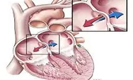 Metode Kateter Ablasi, Atrial Fibrilasi Jantung Bisa Disembuhkan 