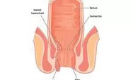 Cara Mengatasi Ambeien atau Hemorrhoid Yang Sering Terjadi 