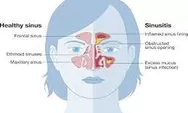 Definisi Dari Sinusitis dan Penyebabnya 