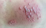 Kenali Penyakit Herpes : Gejala, Cara Menyembuhkan, Hingga Penyebabnya