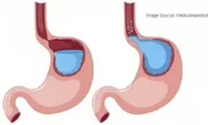 Kenali Tiga Jenis Penyakit Asam Lambung Yang Wajib Diketahui, Begini Penjelasannya