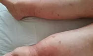 Viral! Pemuda di Tangerang Derita Limfedema, Kakinya Membengkak hingga 50 Kg