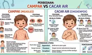 Kasus Campak Naik di Indonesia, Banyak Warga Masih Keliru Bedakan dengan Cacar
