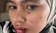 Kartika Putri Berjuang Melawan Penyakit Misterius, Bagikan Kisah Perjuangannya di Instagram