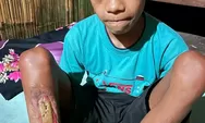 Kisah Mengharukan; Fandi Melawan Infeksi Tulang di Tengah Keterbatasan Ekonomi
