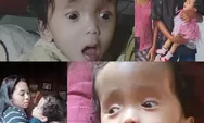 Tolong Selamatkan Stefania, Bayi Malang di Manggarai Timur Yang Berjuang Lawan Hidrosefalus