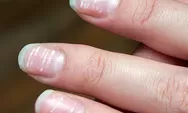 Apa Sih Bercak Putih pada Kuku itu?