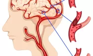 Jangan Anggap Remeh Pusing : Tips Menjaga Kesehatan Pembuluh Darah Otak