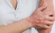 Psoriasis Dampak Autoimun Kulit, Ketahui Gejalanya dan Pengobatannya