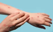 Kasus Mpox Varian Baru di Inggris Naik Lagi, Kini Total 4 Orang Terinfeksi