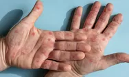 Bagaimana Mpox atau Cacar Monyet Bisa Menular? 6 Kegiatan Ini Harus Dihindari