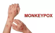 Hampir Mirip! Ini Beda Mpox dan Cacar Air