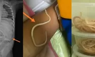 Sebanyak 3 Toples Cacing Pita Ditemukan di Perut Anak 3 Tahun di Jember, Keluhannya Sudah 6 Bulan