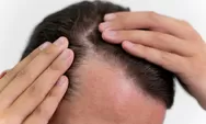 Anda Sering Alami Rambut Rontok Berlebihan, Simak 10 Tips Ini