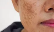 Cara Menghilangkan Flek Hitam di Wajah dengan Bahan Alami