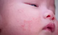 Jangan Panik Jika Anak Mengalami Alergi dan Gatal Gatal, Begini Cara Penanganannya!