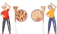 Osteoporosis, Si Pencuri Tulang Senyap: Bahayanya Tak Terlihat Tapi Bisa Bikin Patah Tanpa Sebab