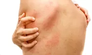 Stevens Johnson Syndrome (SJS): Mengenali Gejala Awal Ruam Kulit yang Berbahaya