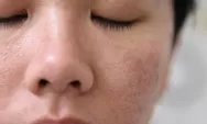 Rahasia Kulit Sehat: Ikuti 6 Cara Memperbaiki Skin Barrier Ini