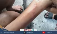 Dituduh Curi Ayam, Anak Kelurahan Margadadi Diduga Dihantam Kayu hingga Lebam