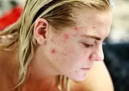 Cara Mengatasi Alergi Skincare di Kulit Wajah, Atasi dengan Saran Ini!