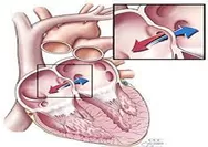 Metode Kateter Ablasi, Atrial Fibrilasi Jantung Bisa Disembuhkan 