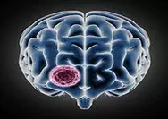 Waspada Gejala Tumor Otak, Penglihatan Kabur Kepala Sedikit Pusing