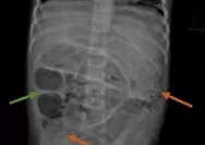 Sebanyak 3 Toples Cacing Pita Ditemukan di Perut Anak 3 Tahun di Jember, Keluhannya Sudah 6 Bulan