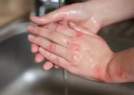 Wabah Cacar Air Meluas di Sekolah! Apakah Anak Anda Aman?