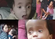 Tolong Selamatkan Stefania, Bayi Malang di Manggarai Timur Yang Berjuang Lawan Hidrosefalus